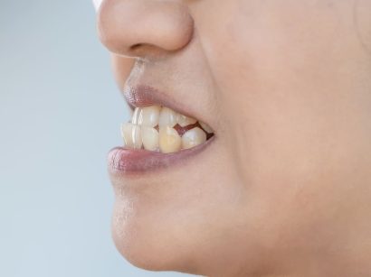 Mușcătura inversă: retruzie maxilară vs. prognatism mandibular
