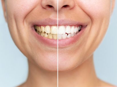Cât durează efectul albirii dentare și cum îl menții? Ghid post-procedură